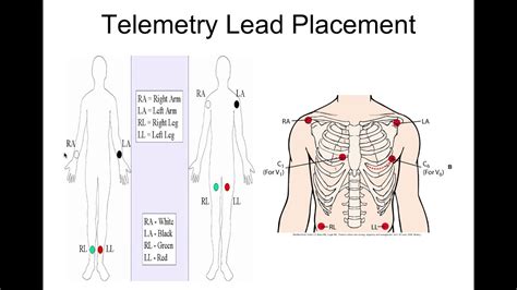 lv lead placement techniques|pacemaker telemetry lead placement.